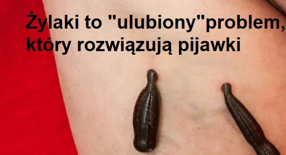 Dwie pijawki medyczne przysysające się do skóry pacjenta, widoczne ślady po ugryzieniach, czerwone tło po lewej stronie.