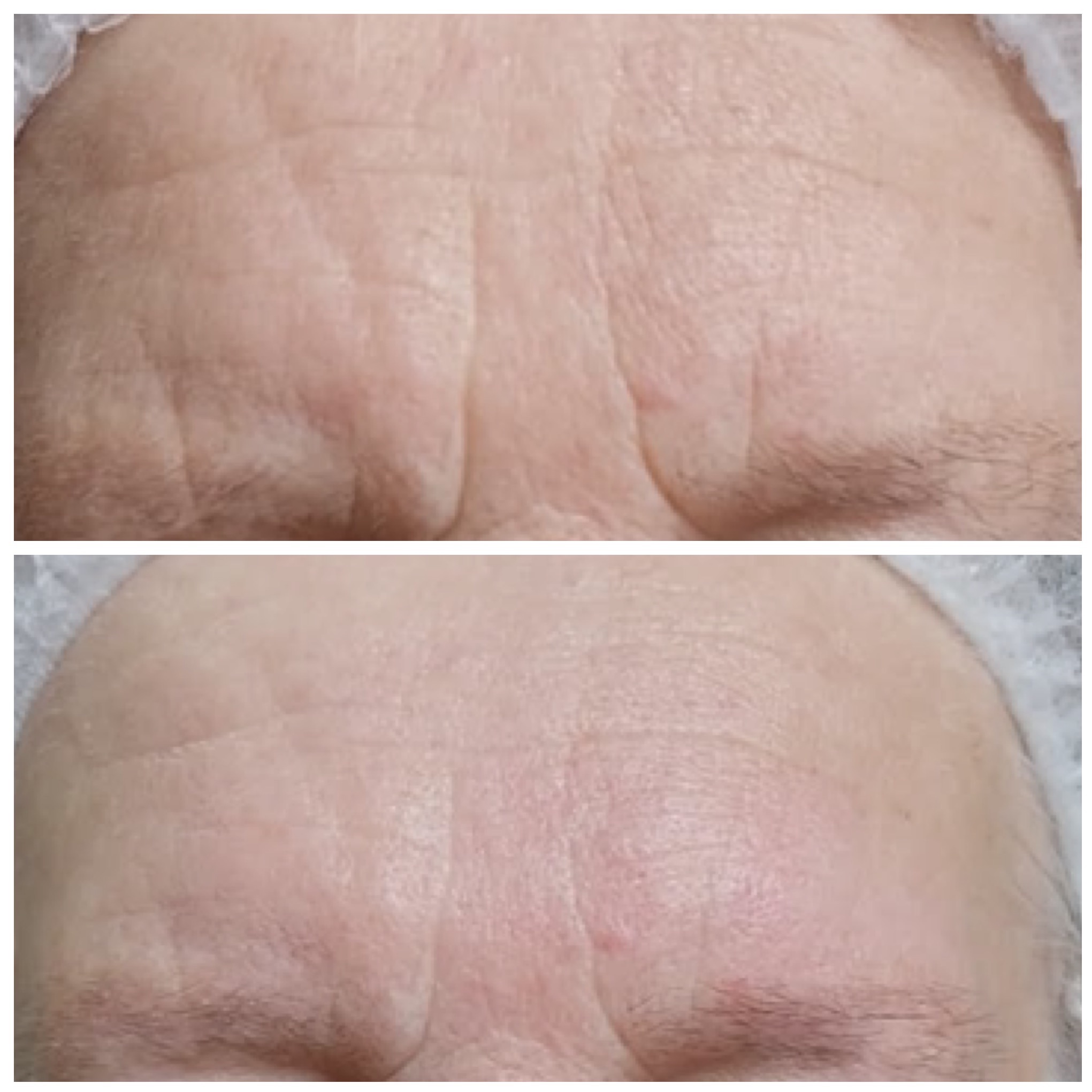 Zdjęcie 'przed i po' redukcji zmarszczek na czole, ukazujące różnicę w gładkości skóry. Widoczne delikatne zaczerwienienie po zabiegu.