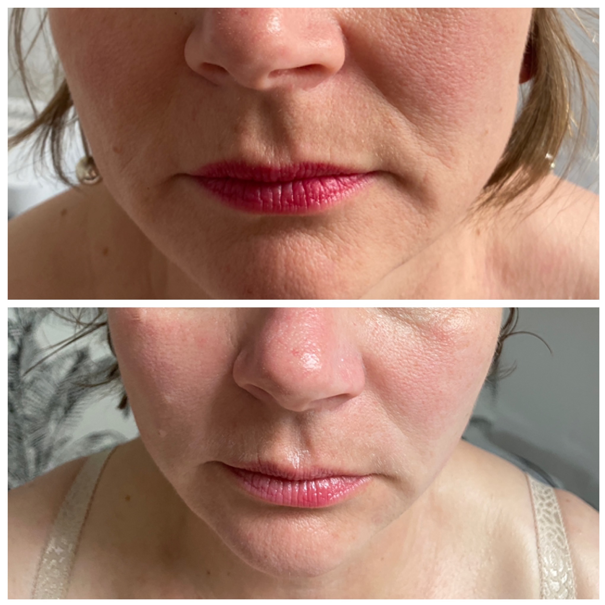 Zdjęcie 'przed i po' zabiegu na usta i okolice ust. Widoczne zmiany w zmarszczkach i nawilżeniu skóry. Ujęcie makro, skupione na twarzy kobiety.