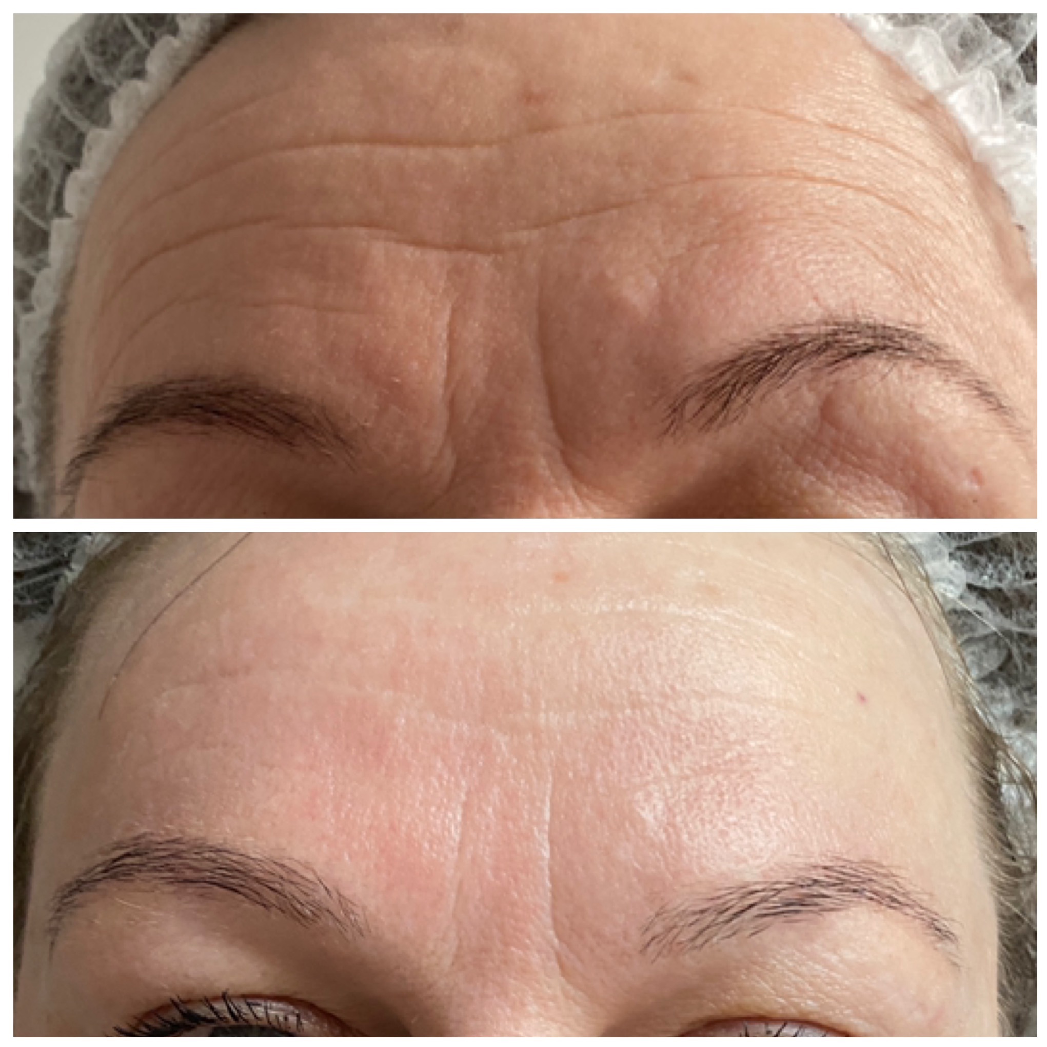 Zdjęcie 'przed i po' redukcji zmarszczek na czole. Górna część pokazuje wyraźne zmarszczki, dolna - wygładzoną skórę po zabiegu.