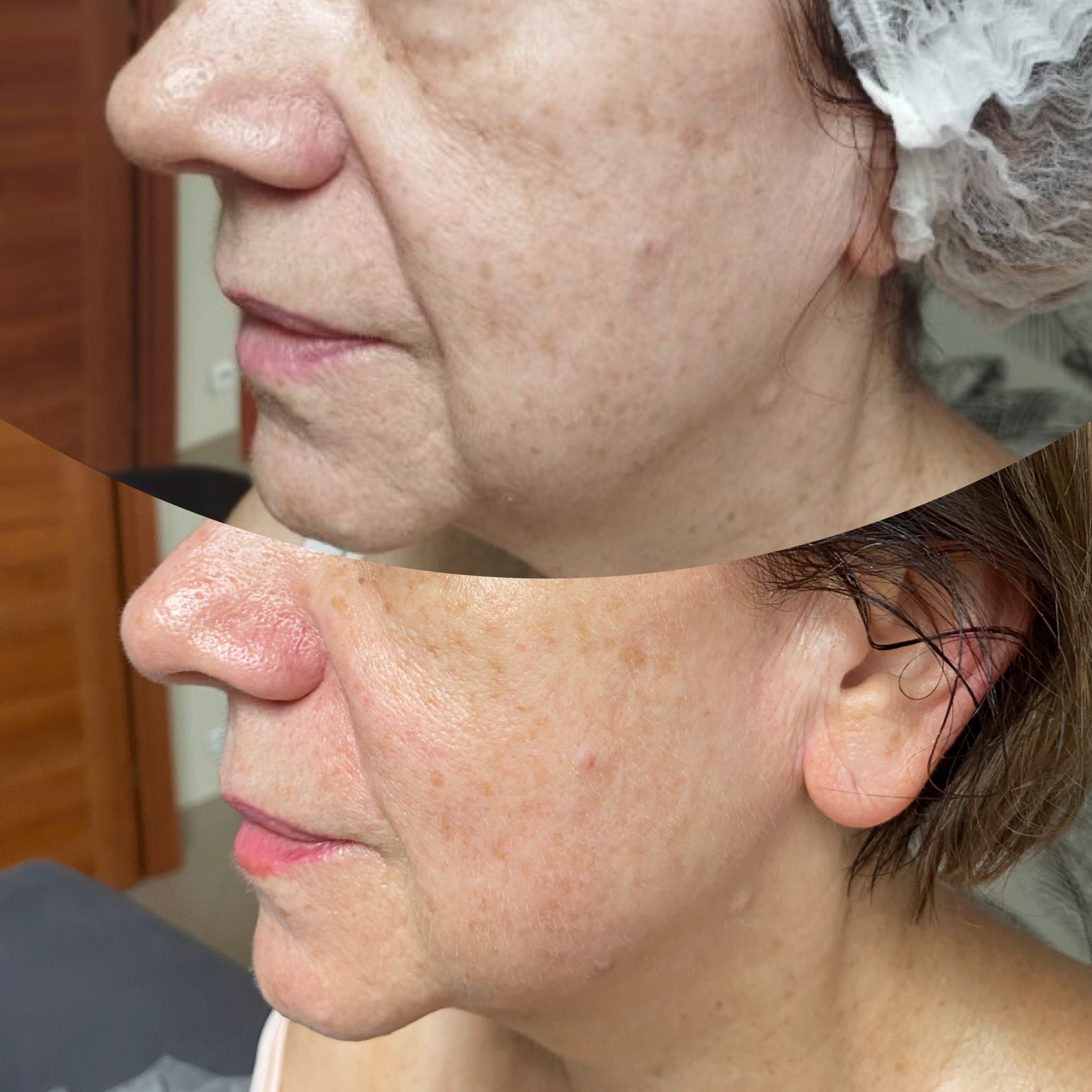 Zdjęcie 'przed i po' zabiegu na twarz, ukazujące poprawę napięcia skóry. Profil kobiety z widocznymi zmarszczkami przed i gładszą skórą po zabiegu.