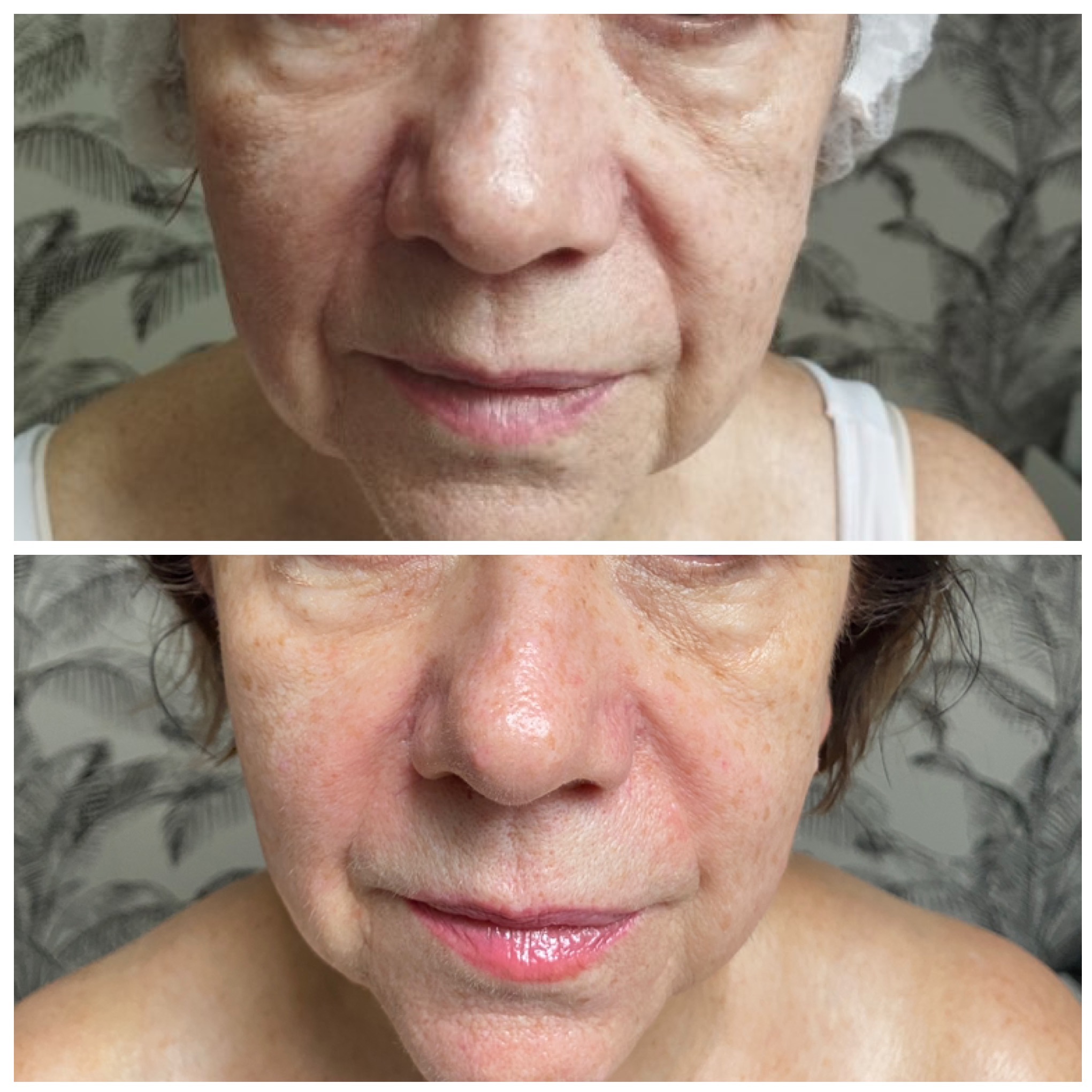 Zdjęcie 'przed i po' zabiegu kosmetycznego na twarz starszej kobiety. Na górze skóra przed, na dole po zabiegu, z widocznym efektem poprawy kolorytu i nawilżenia.