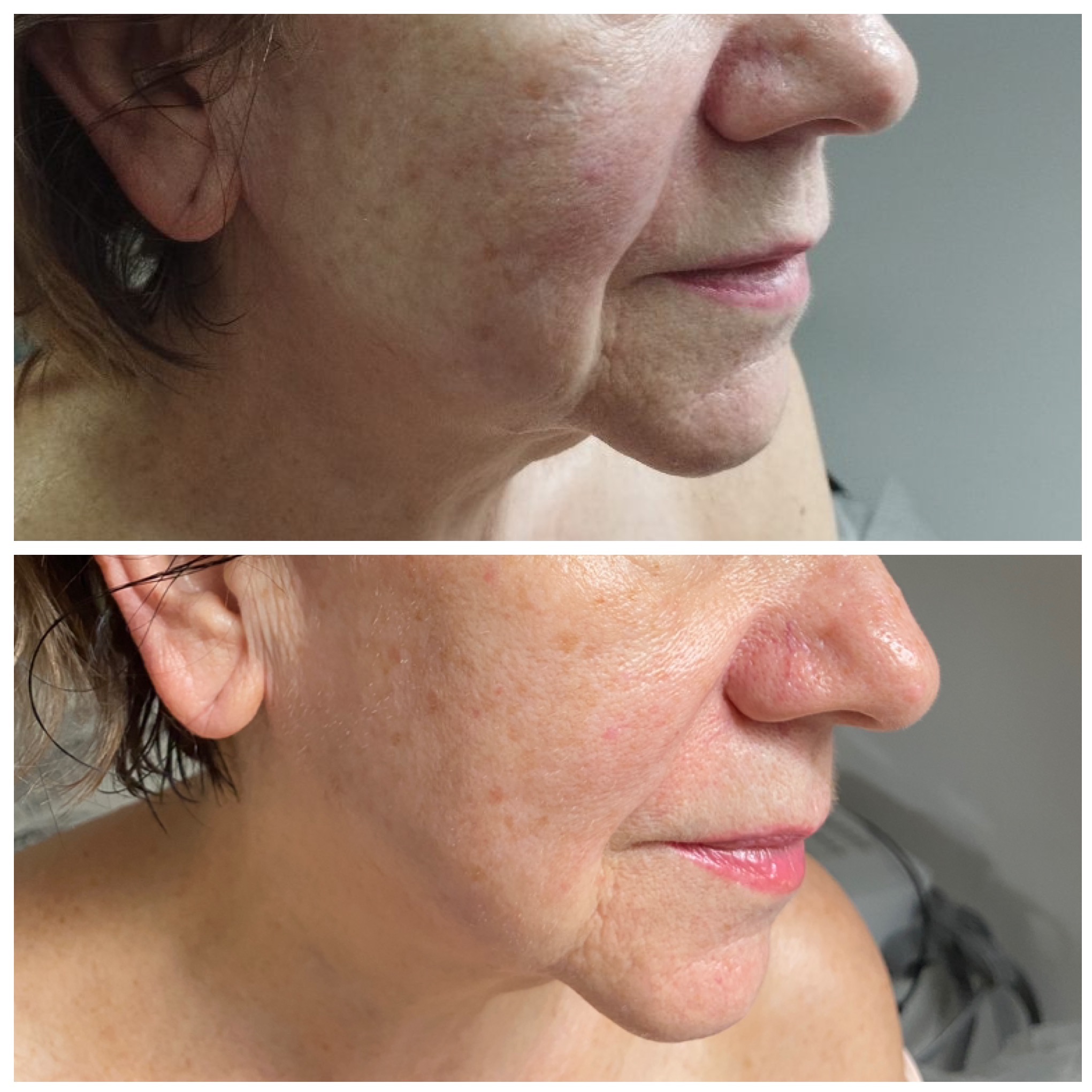 Zdjęcie 'przed i po' zabiegu na twarz. Górna część ukazuje skórę przed, a dolna po zabiegu, z widoczną poprawą jędrności i kolorytu skóry.