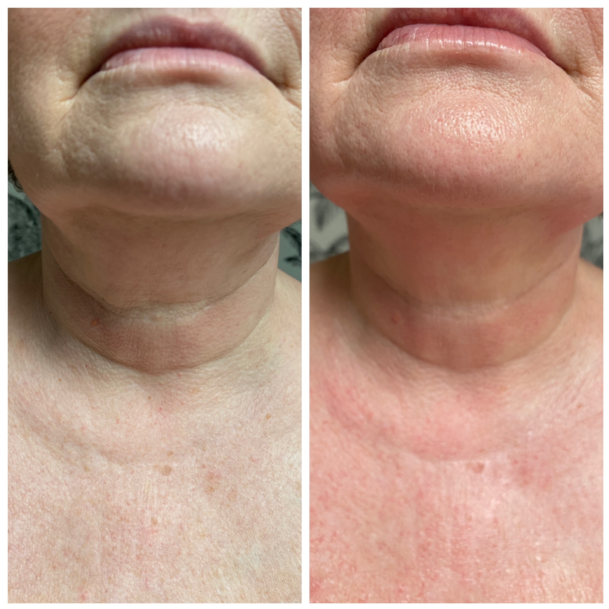 Zdjęcie 'przed i po' zabiegu na szyję. Widoczne zmniejszenie wiotkości skóry i poprawa jej napięcia. Skóra po zabiegu jest bardziej gładka i jednolita.