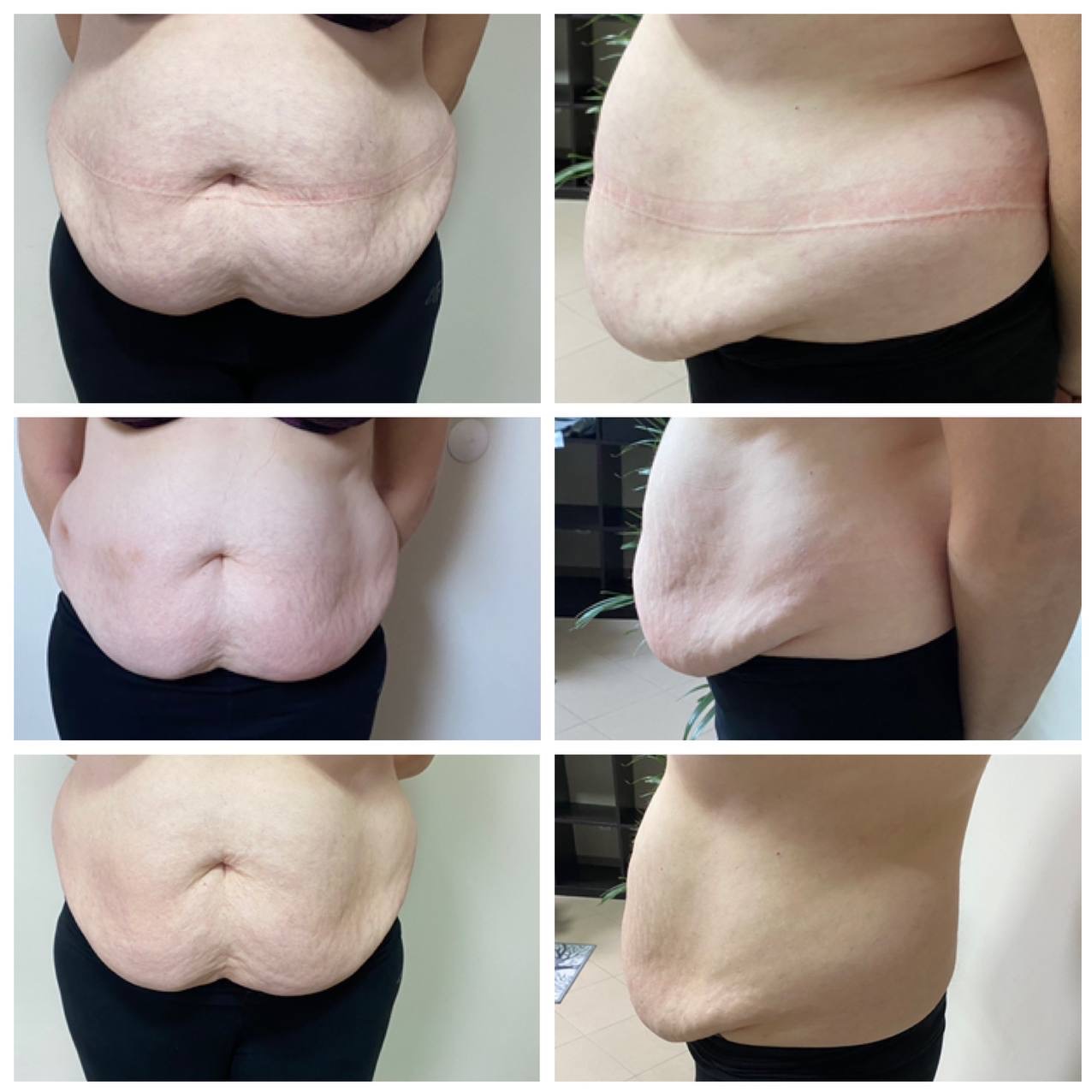 Efekt zabiegu: kolaż 6 zdjęć brzucha przed i po zabiegu. Widoczna blizna po operacji plastycznej. Ujęcie z przodu i z boku, pokazujące różnicę w wyglądzie brzucha.