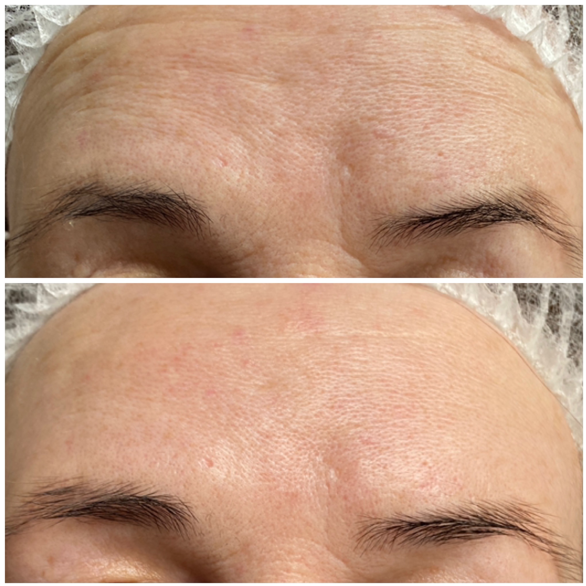 Zdjęcie 'przed i po' zabiegu na zmarszczki mimiczne czoła. Widoczne brwi i skóra czoła z wyraźną poprawą po zabiegu, skóra bardziej gładka.