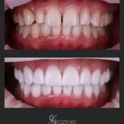 Porównanie stanu zębów przed i po zabiegu: górny rząd zębów z przebarwieniami i nierównościami, dolny rząd zębów po korekcie, z idealnym kształtem i kolorem.