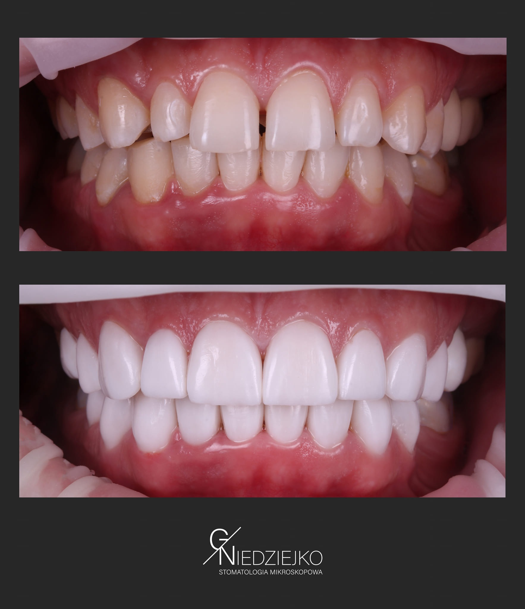 Porównanie stanu zębów przed i po zabiegu: górny rząd zębów z przebarwieniami i nierównościami, dolny rząd zębów po korekcie, z idealnym kształtem i kolorem.