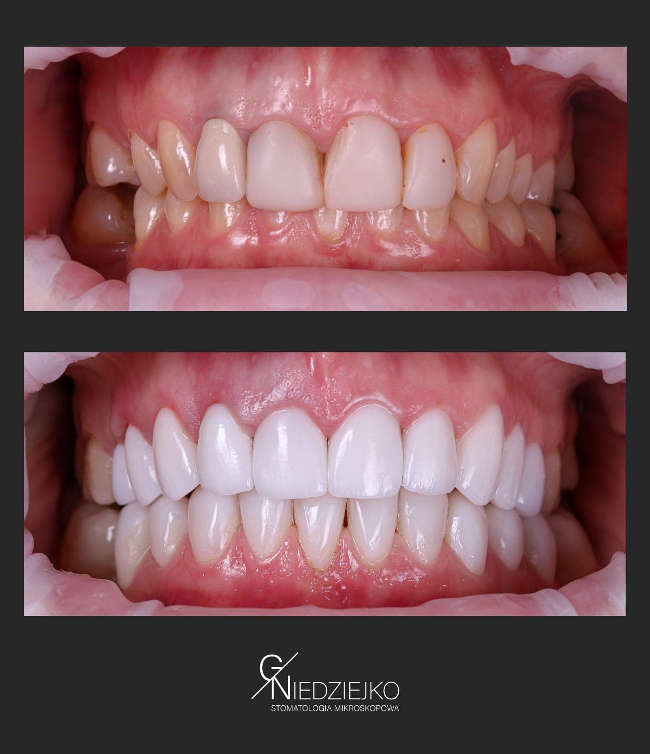 Porównanie stanu zębów przed i po zabiegu: górne zęby z przebarwieniami i ubytkami, dolne zęby po zabiegu, równe i białe.