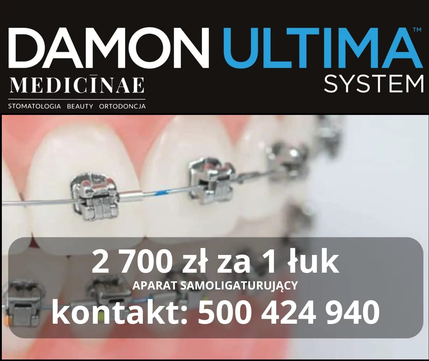 Aparat samoligaturujący Damon Ultima na zębach, promowany w Opole. Cena za łuk: 2700 zł. Kontakt telefoniczny widoczny na zdjęciu.