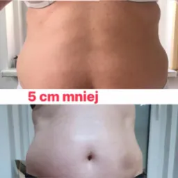 Efekt zabiegów modelujących i wspomagających odchudzanie Techni Spa +elektrostymulacja