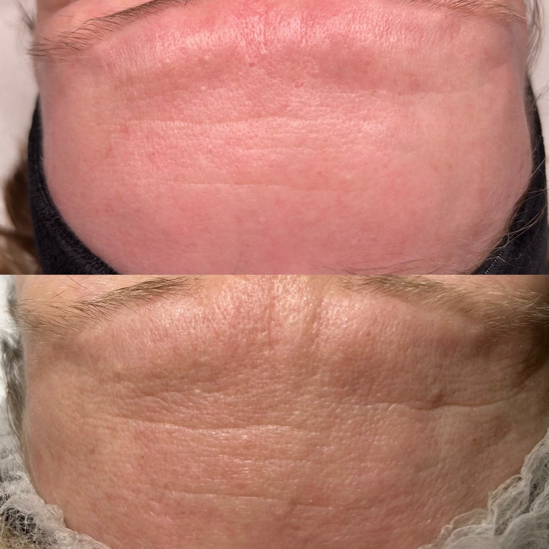 Porównanie skóry czoła przed i po zabiegu: góra - skóra z widocznymi zmarszczkami, dół - skóra po zabiegu, zredukowane zmarszczki i poprawiona tekstura.