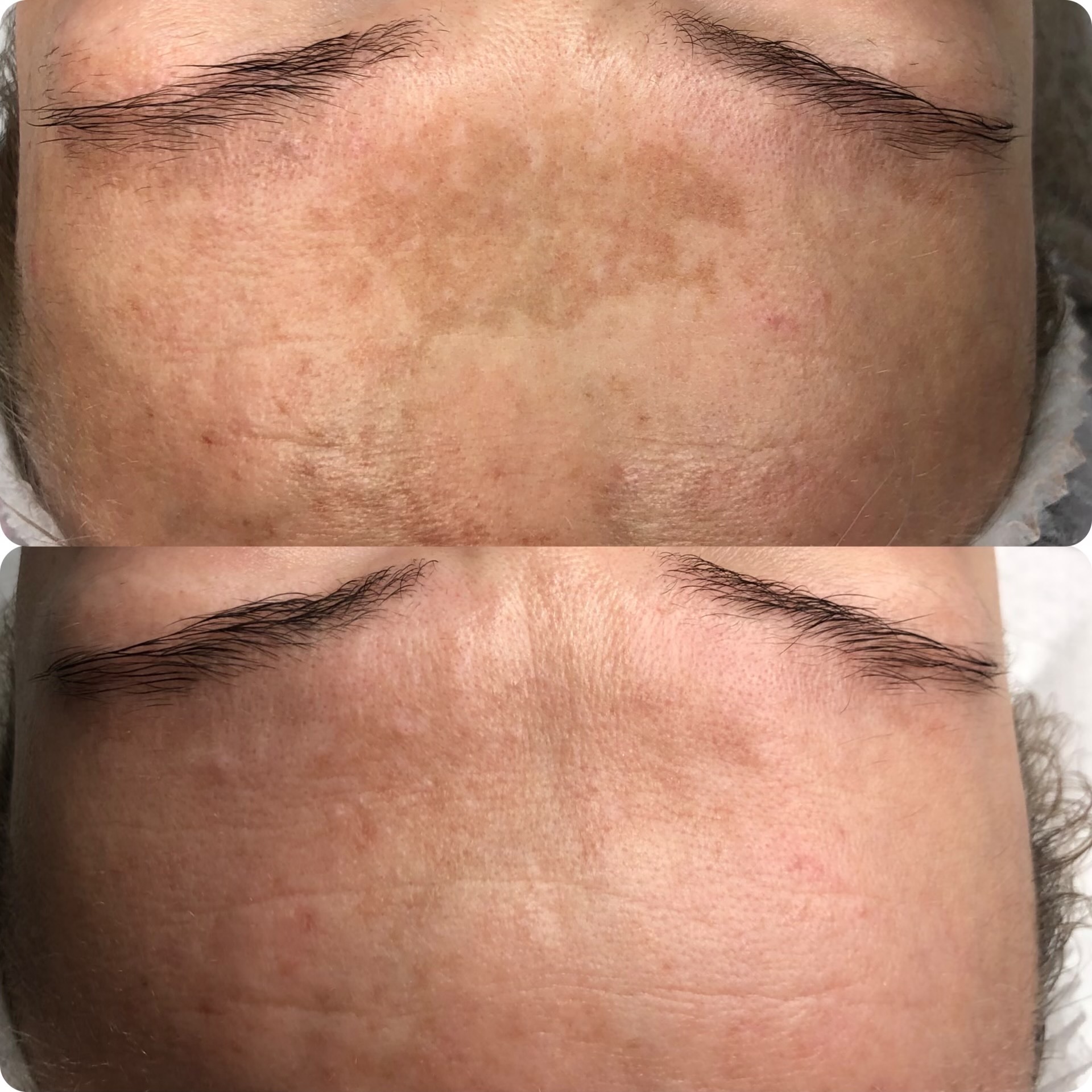 Zdjęcie 'przed i po' przedstawia skórę czoła z widocznymi przebarwieniami przed zabiegiem oraz skórę po zabiegu, z redukcją przebarwień.