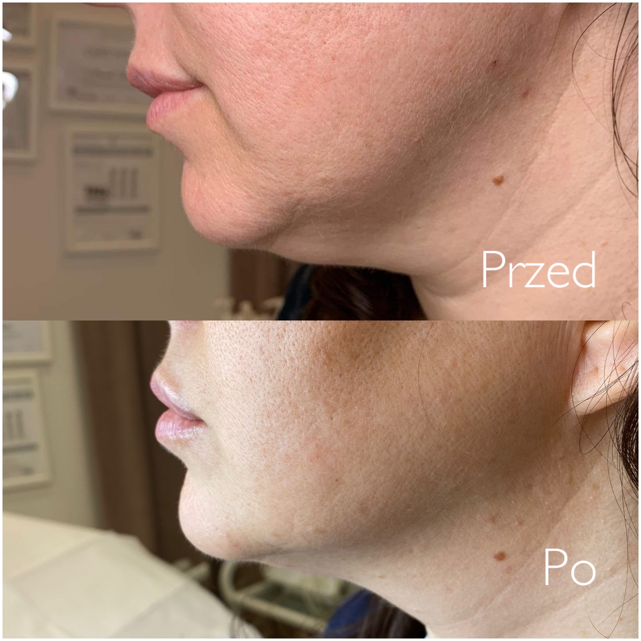 Porównanie 'przed' i 'po' zabiegu redukcji podwójnego podbródka, widok z profilu, ukazujący poprawę napięcia skóry szyi.