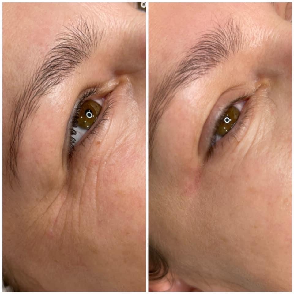 Zdjęcie 'przed i po' z bliska ukazuje skórę wokół oka po zabiegu w Gdańsku, redukcja zmarszczek widoczna po prawej stronie.