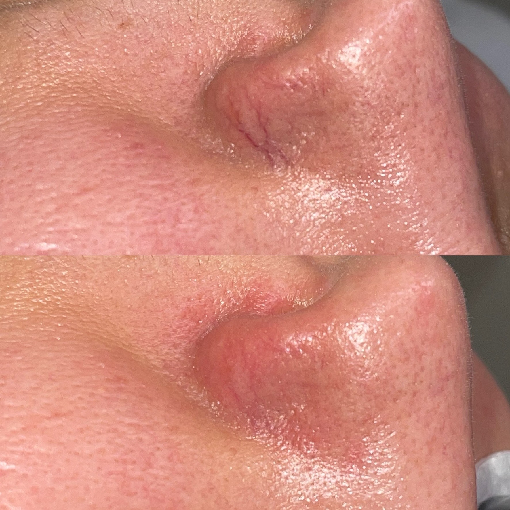 Zbliżenie na fragment twarzy przed i po zabiegu redukcji naczynek na nosie. Widoczne zmiany w strukturze skóry i zmniejszenie widoczności naczynek.