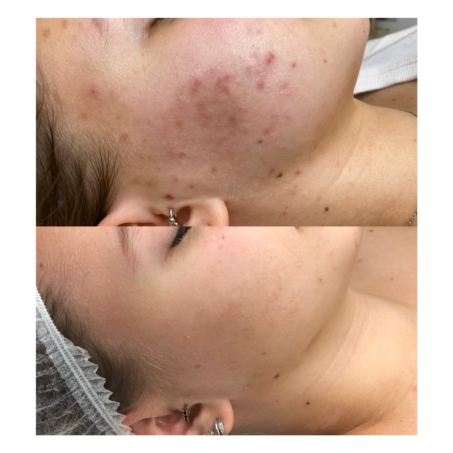 Zdjęcie typu 'przed i po' prezentujące efekt zabiegu na skórze twarzy, widoczne zaczerwienienia i zmiany trądzikowe przed zabiegiem oraz wyraźne zmniejszenie tych zmian po zabiegu, z kolczykiem w uchu