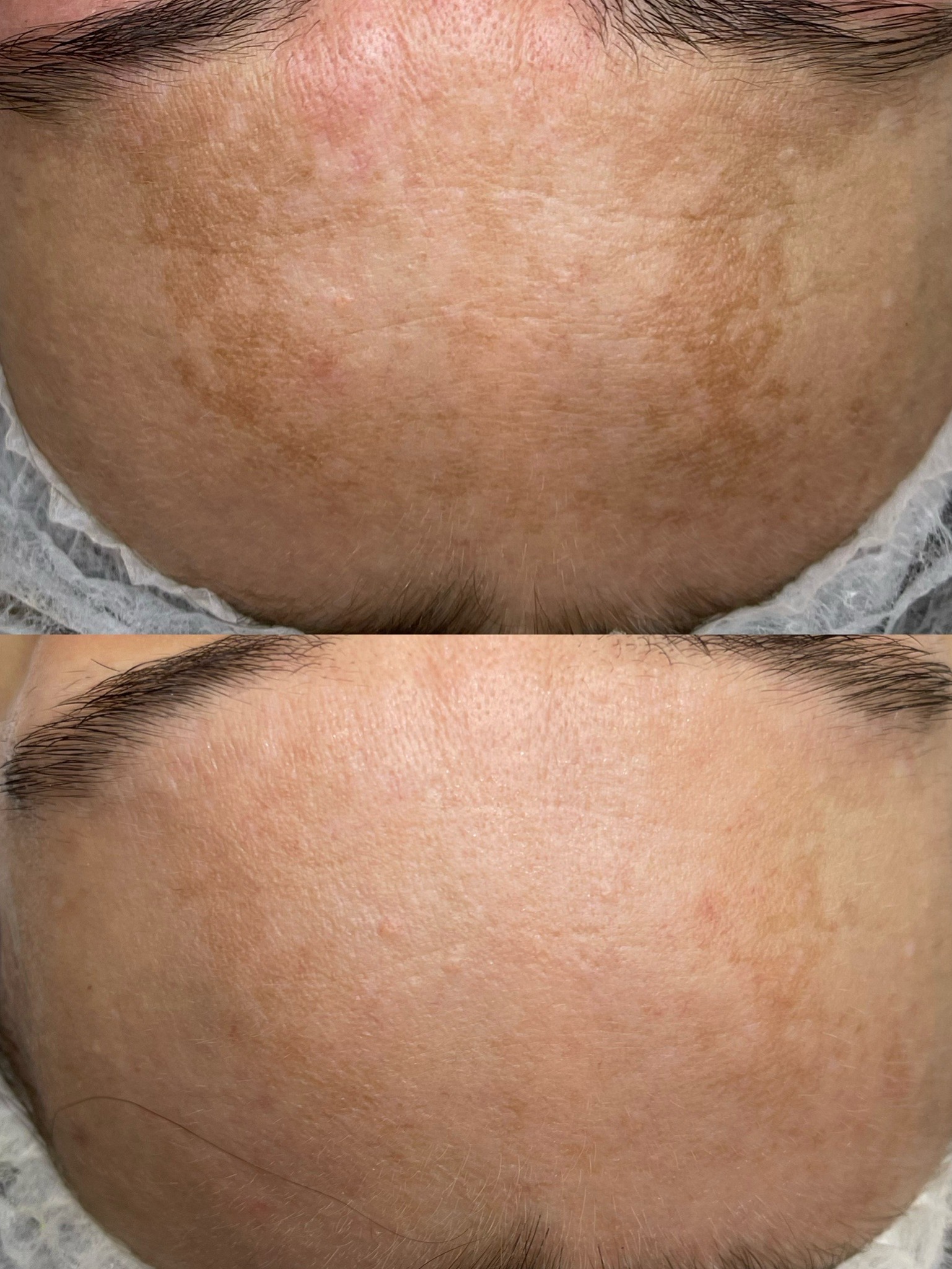 Porównanie skóry czoła przed i po zabiegu redukcji przebarwień, widoczne wyraźne rozjaśnienie i ujednolicenie kolorytu.