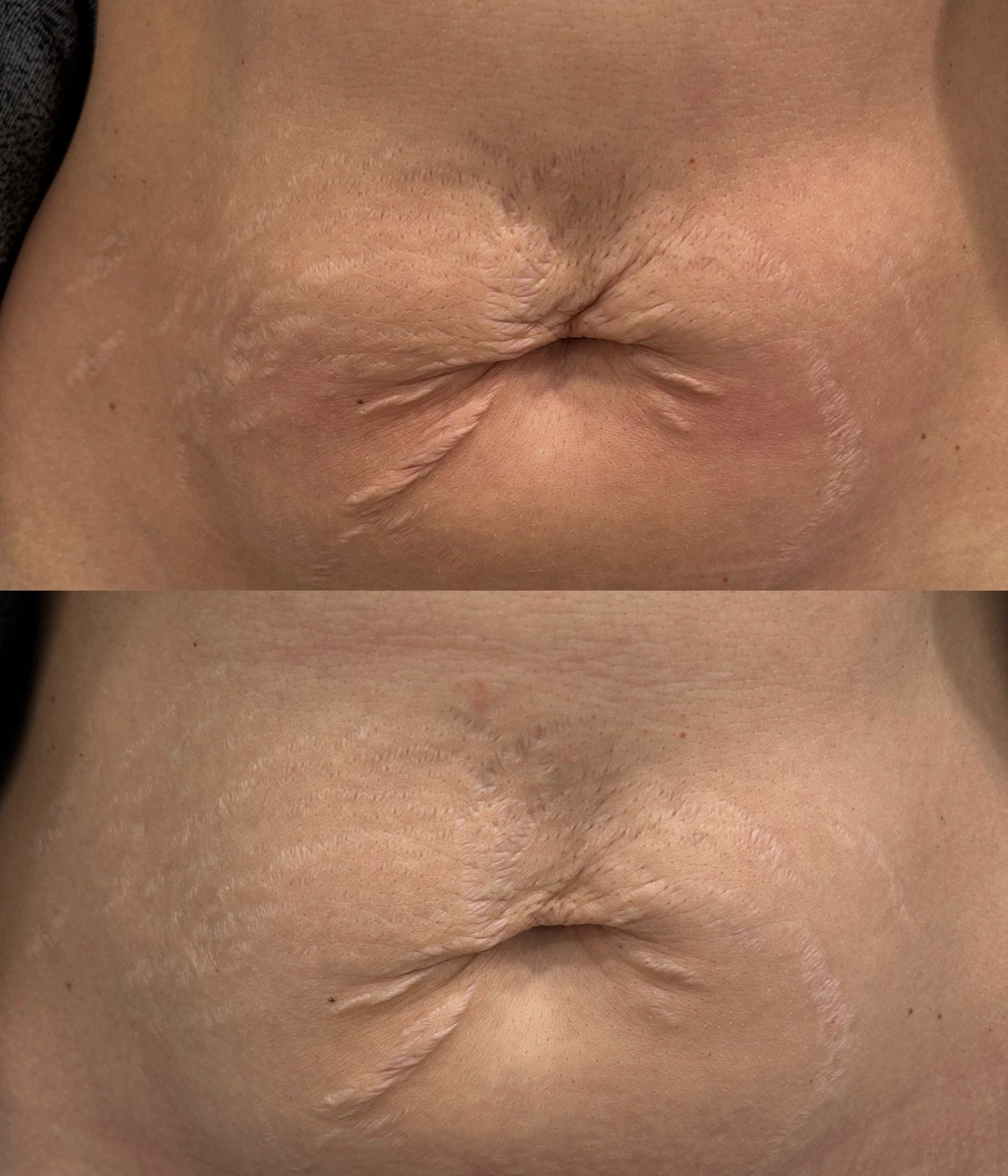 Brzuch kobiety przed i po zabiegu redukcji rozstępów, widoczne zmiany w strukturze skóry wokół pępka.