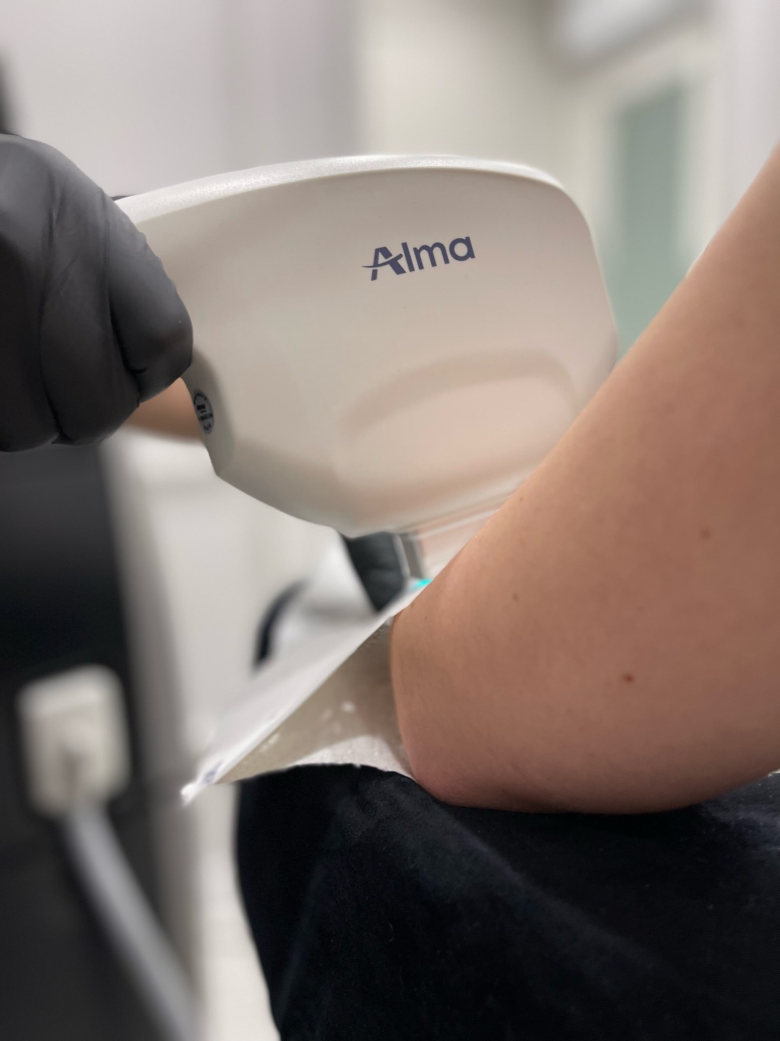 Zabieg laserowy na skórze ramienia wykonywany urządzeniem marki Alma, widoczne czarne rękawice ochronne i fragment białego ręcznika.