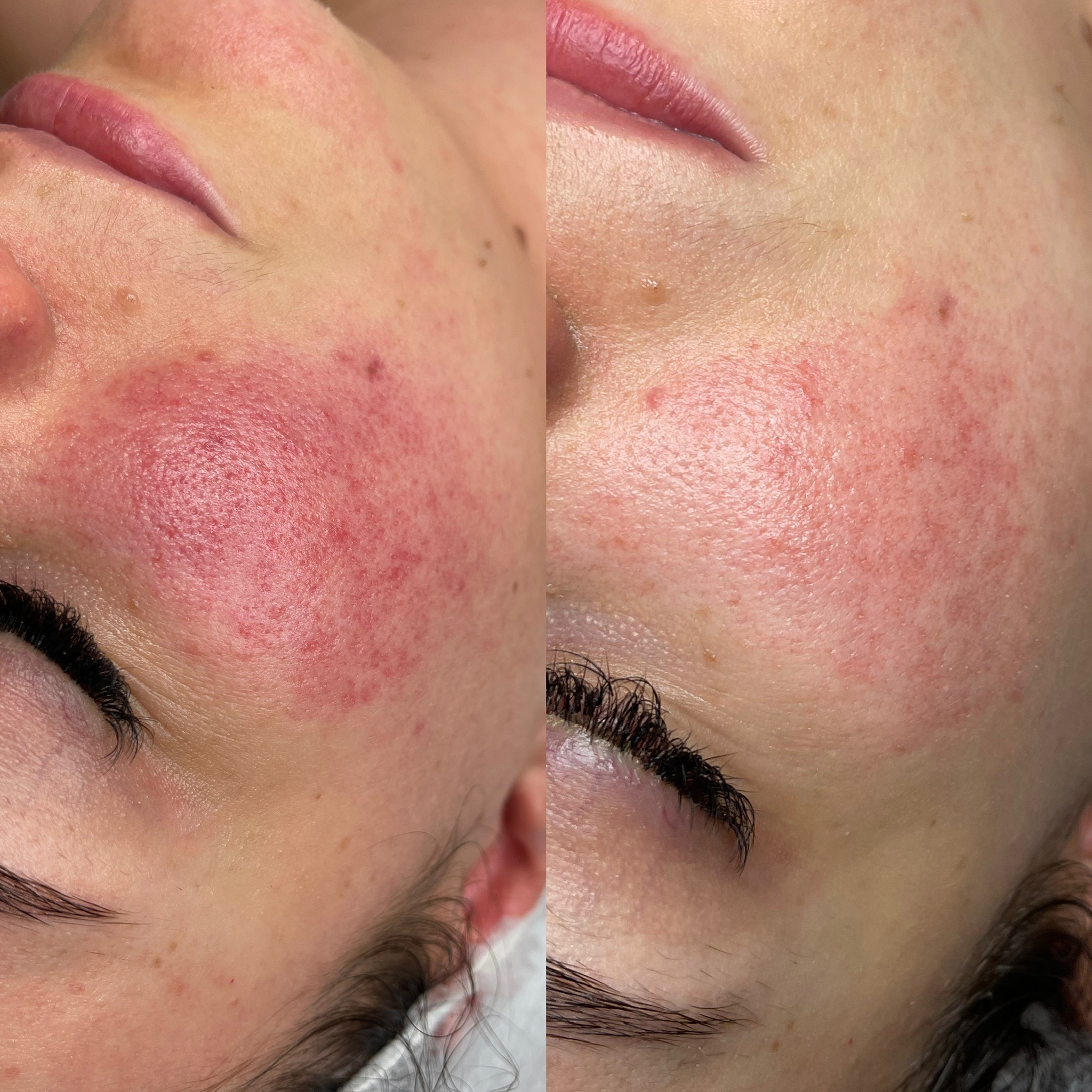 Zdjęcie 'przed i po' zabiegu na twarz, ukazujące redukcję zaczerwienienia i poprawę stanu skóry w okolicy policzka i oka.