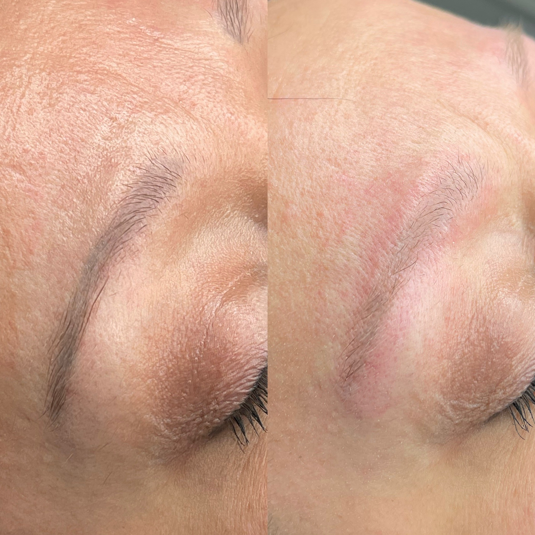 Zbliżenie na skórę twarzy przed i po zabiegu na brwi, widoczne zaczerwienienie i różnica w wyglądzie.