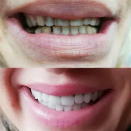 Zdjęcie przedstawia porównanie uśmiechu przed i po zabiegu: górna część ukazuje zęby przed, z widocznymi przebarwieniami i nierównościami, dolna część prezentuje uśmiech po zabiegu, z idealnie...