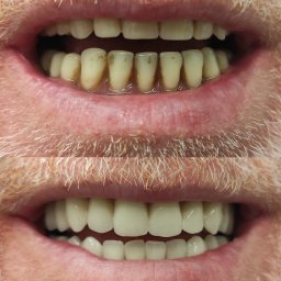 Dental Technik - Zdjęcie 'przed i po' przedstawiające górny rząd zębów przed i po zabiegu protetycznym, ukazujące różnicę w wyglądzie i kolorze zębów.