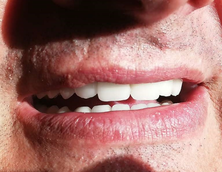 Uśmiech mężczyzny z nowymi, bardzo białymi zębami; zbliżenie na usta i zęby w jasnym oświetleniu.