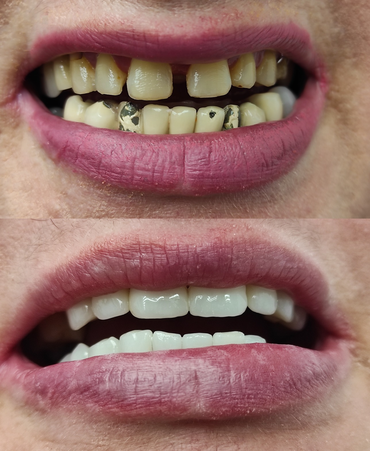 Zbliżenie ust przed i po zabiegu protetycznym; górny kadr ukazuje zęby z ubytkami i starymi plombami, dolny kadr prezentuje pełny uśmiech z nowymi, białymi zębami.