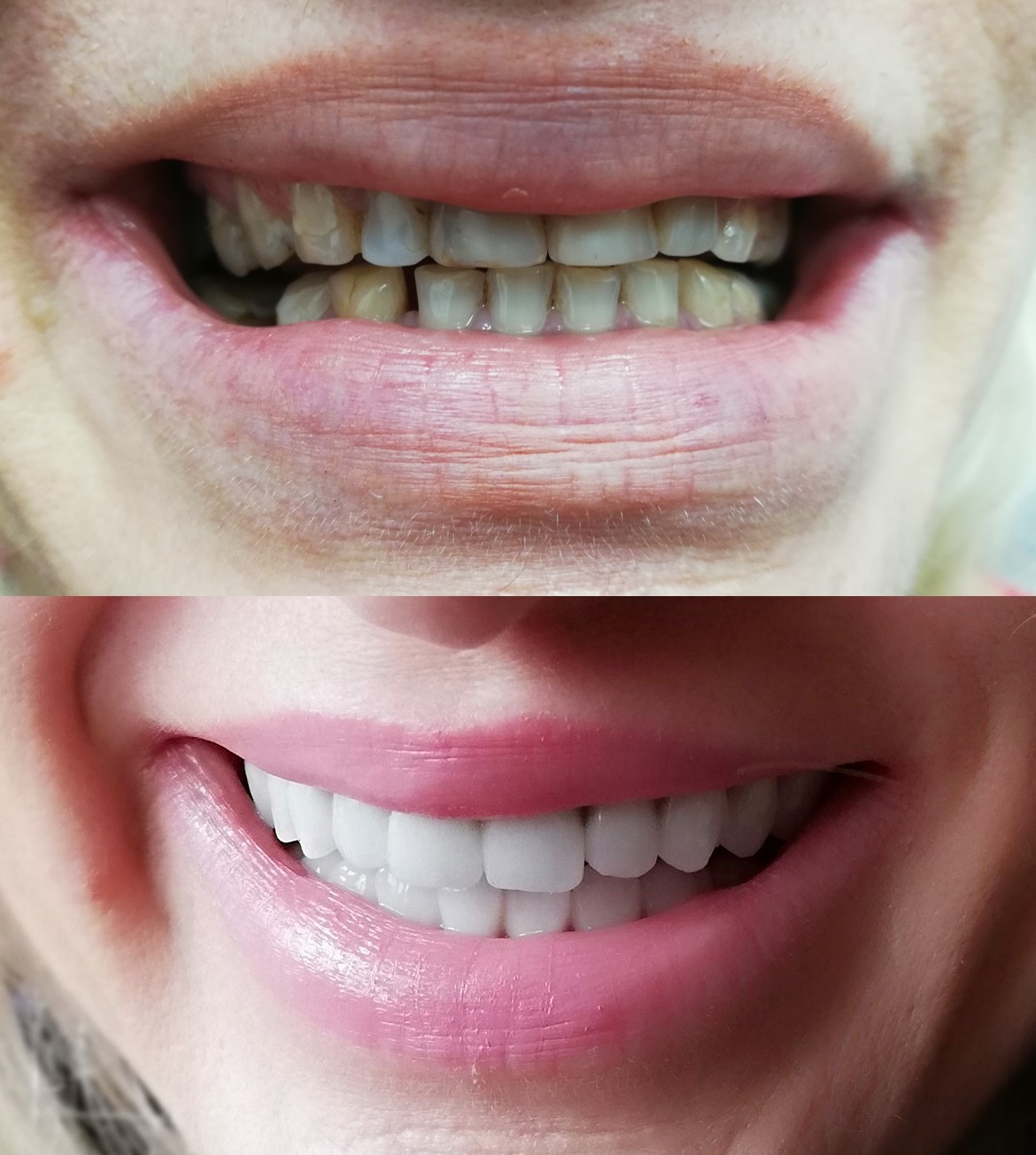 Zdjęcie przedstawia porównanie uśmiechu przed i po zabiegu: górna część ukazuje zęby przed, z widocznymi przebarwieniami i nierównościami, dolna część prezentuje uśmiech po zabiegu, z idealnie...