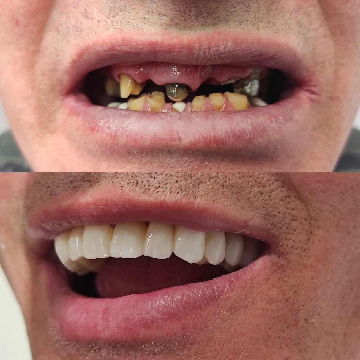 Zdjęcie przedstawia porównanie stanu uzębienia przed i po zabiegu: górny kadr ukazuje zniszczone zęby z widocznymi ubytkami i starymi plombami, dolny kadr prezentuje pełny uśmiech z nowymi, białymi...