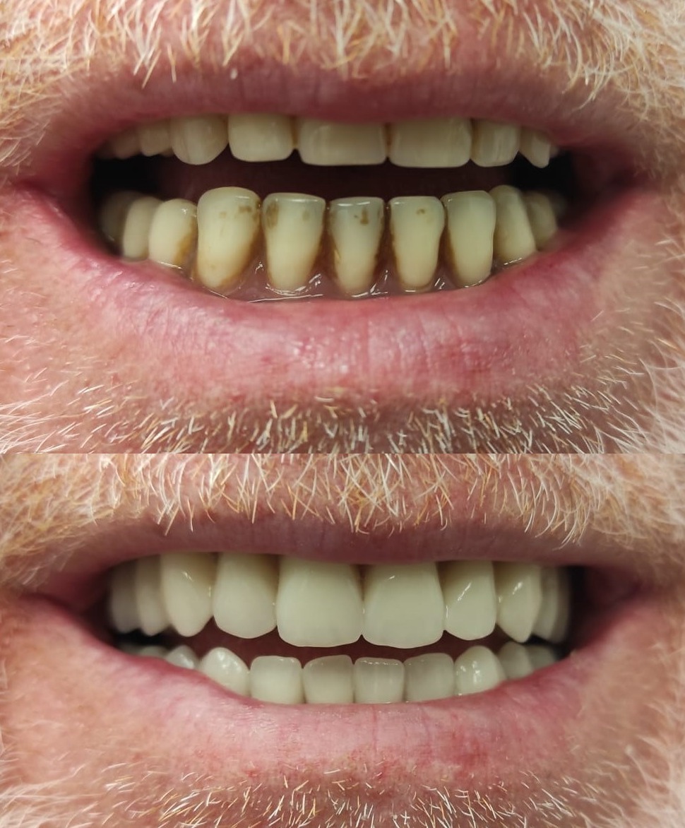 Zdjęcie 'przed i po' przedstawiające górny rząd zębów przed i po zabiegu protetycznym, ukazujące różnicę w wyglądzie i kolorze zębów.