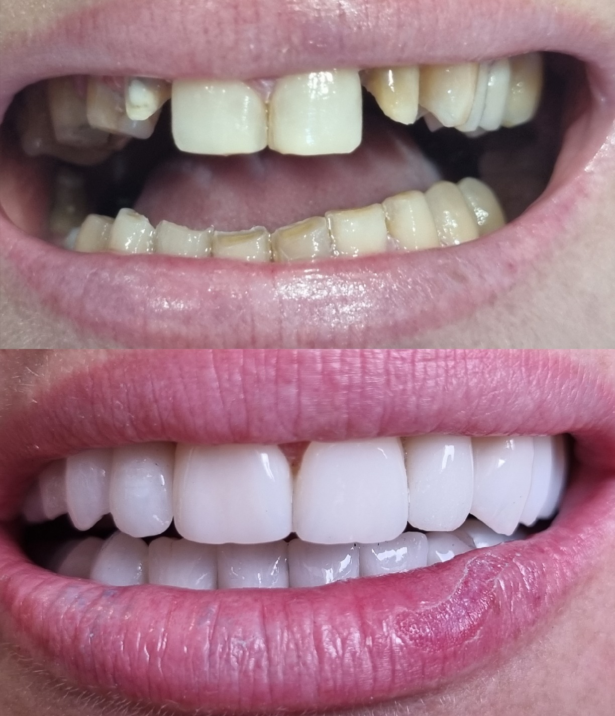 Porównanie stanu uzębienia przed i po zabiegu: górna część zdjęcia ukazuje zęby z ubytkami i przebarwieniami, dolna część prezentuje pełny uśmiech z idealnie białymi licówkami.