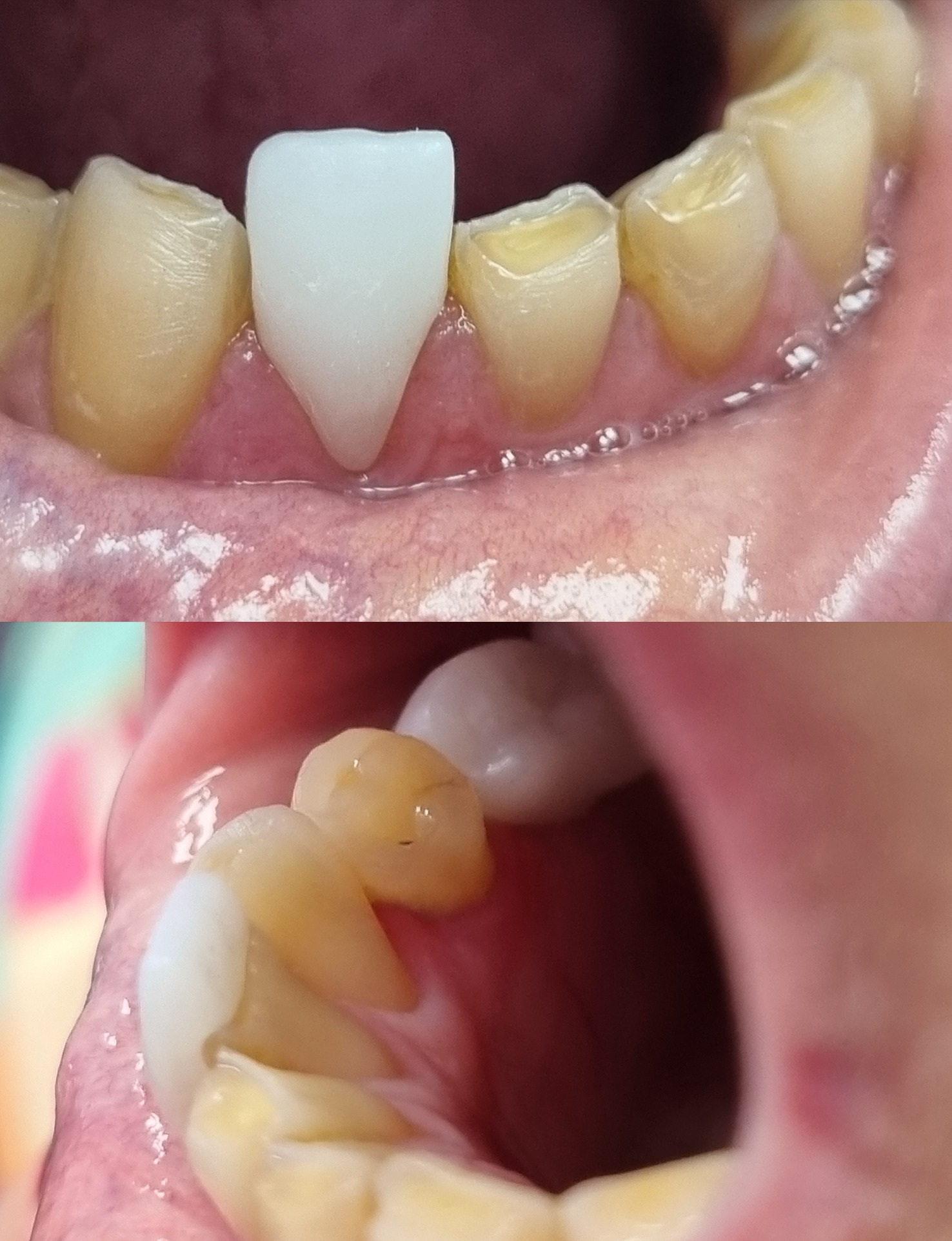 Widok z bliska na ząb z nową, białą koroną protetyczną w górnej szczęce, otoczony przez naturalne zęby z widocznymi przebarwieniami i osadem, oraz dolny rząd zębów z widoczną koroną i dziąsłem.