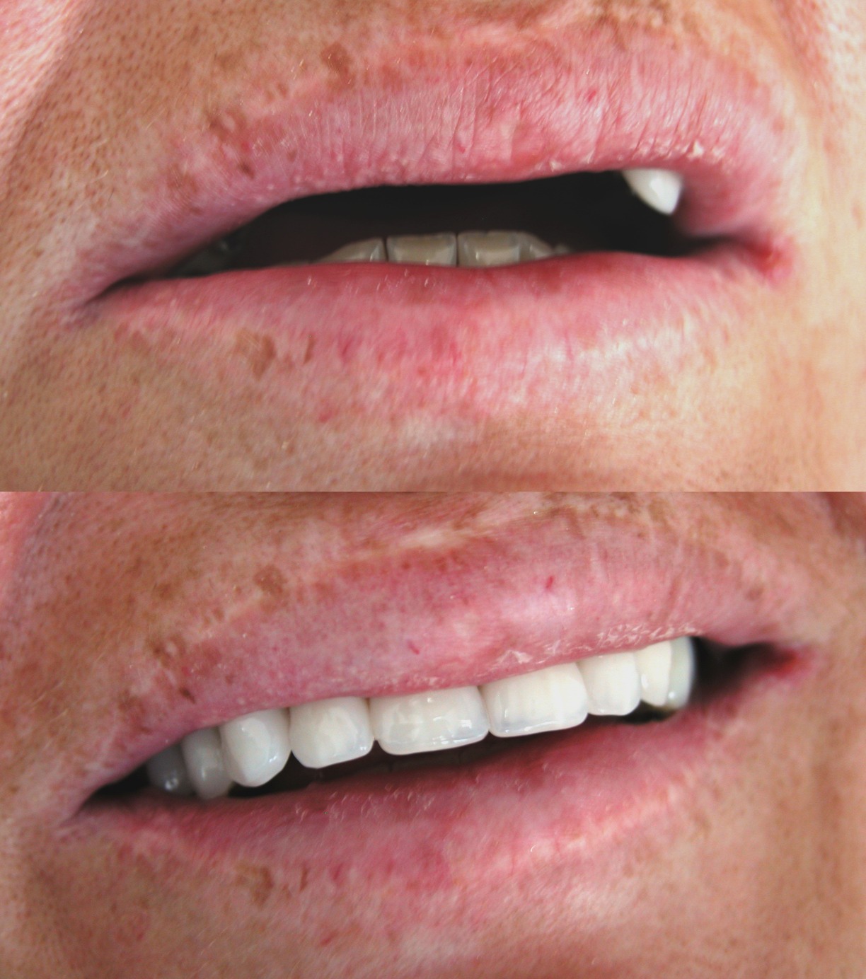 Zdjęcie przedstawia zbliżenie ust pacjenta przed i po zabiegu protetycznym, ukazującym różnicę w wyglądzie i ułożeniu zębów. Górna część zdjęcia pokazuje usta z widocznym brakiem zęba, natomiast...