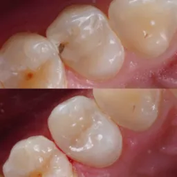 Makro zbliżenie na ząb trzonowy przed i po wypełnieniu kompozytowym, widoczne niewielkie przebarwienia na powierzchni szkliwa.