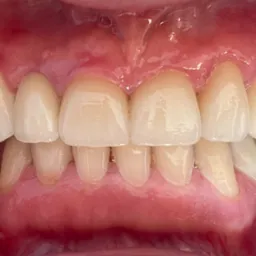 Widok z bliska uzębienia po zabiegu protetycznym z widocznymi koronami na górnych zębach i mostem na dolnych zębach