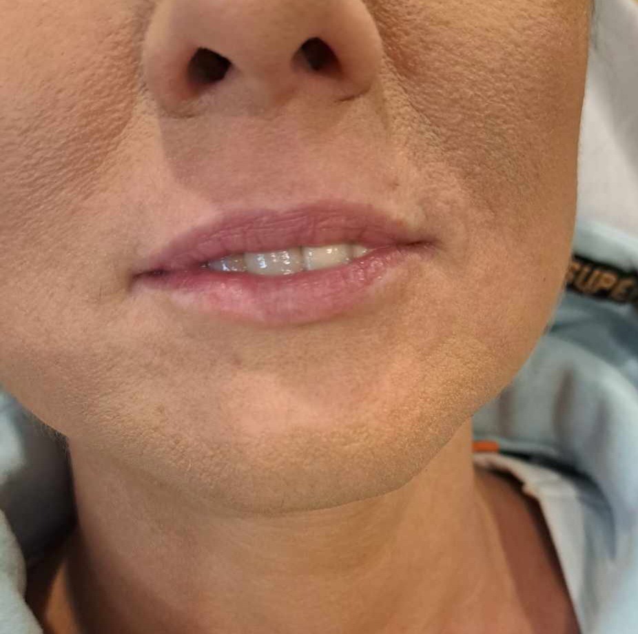 Bliski kadr na twarz kobiety z widocznymi ustami i zębami, skóra pokryta podkładem, przygotowana do zabiegu.