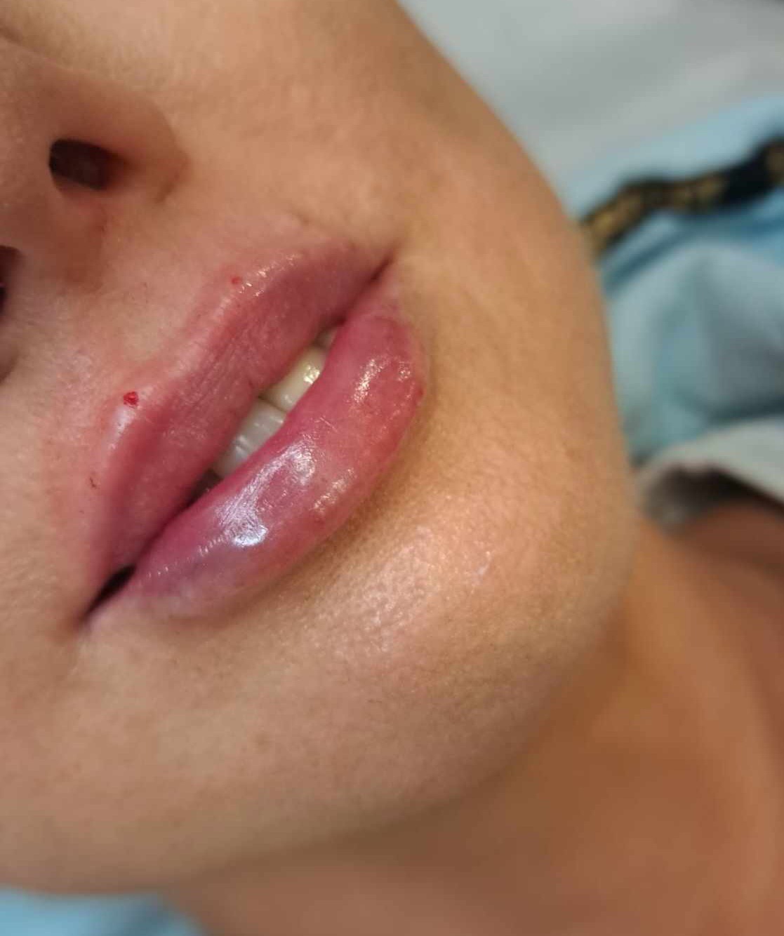 Powiększone usta pacjentki z Ciechanowa, widoczne drobne ślady po zabiegu, lekka opuchlizna i zaczerwienienie.