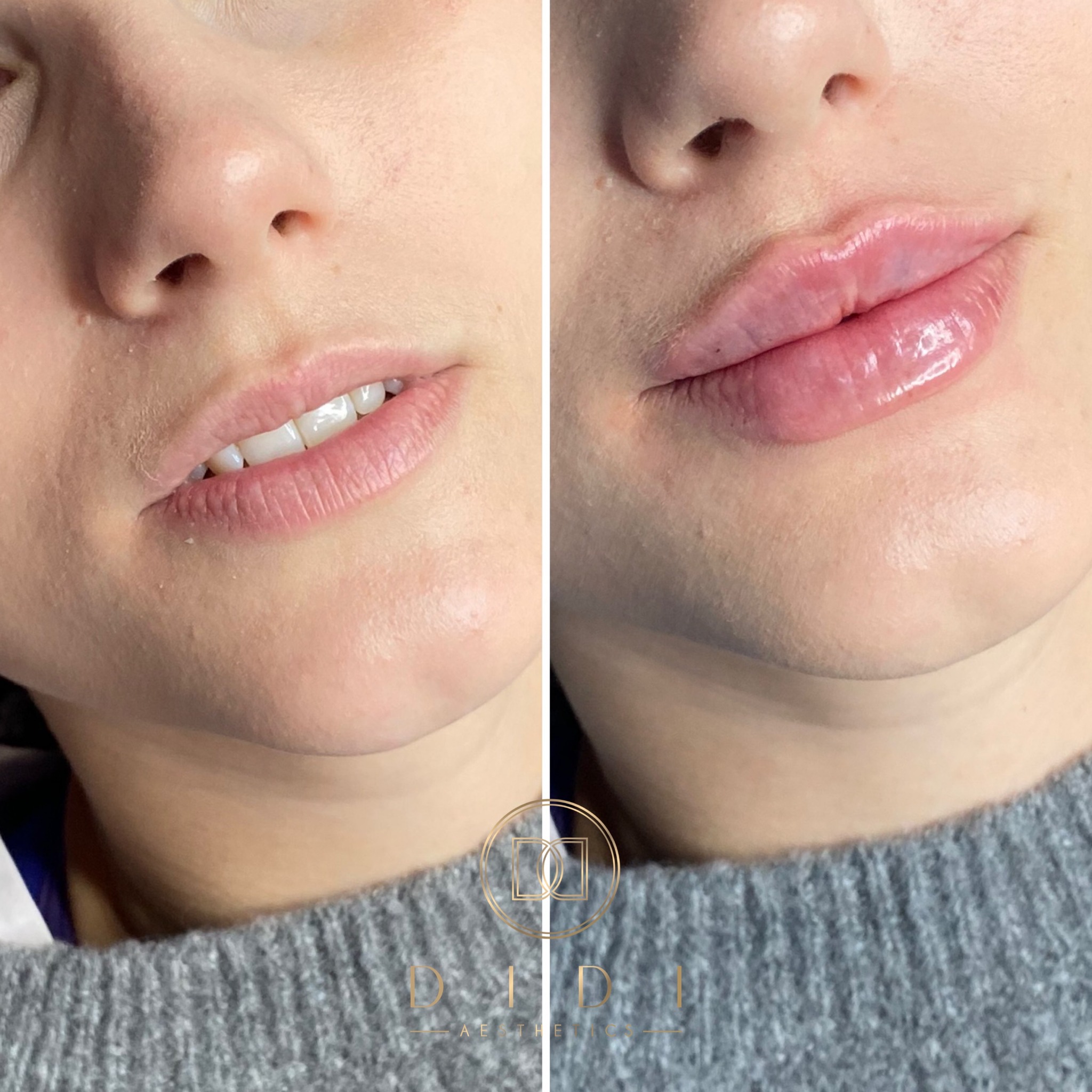 Powiększanie Ust kwasem hialuronowym na płasko Powiększanie ust techniki rosyjskie Russian lips