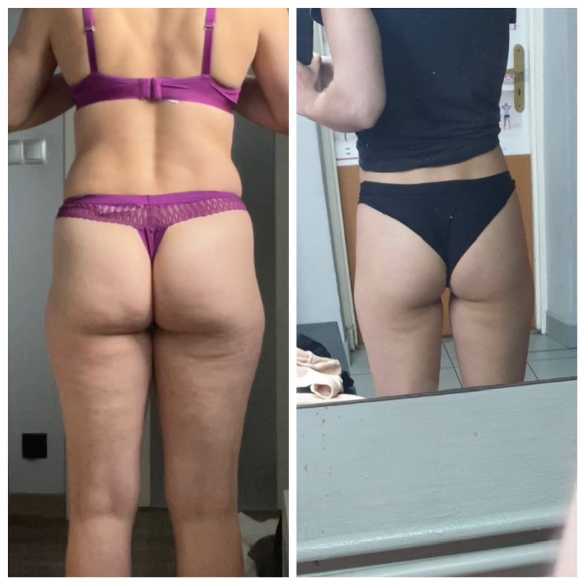 Zdjęcie 'przed i po' z widocznymi zmianami w wyglądzie sylwetki, szczególnie w obszarze ud i pośladków. Po lewej stronie widoczny cellulit, po prawej skóra bardziej napięta.
