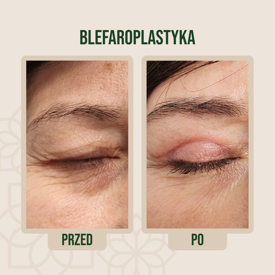 Korekta powiek górnych