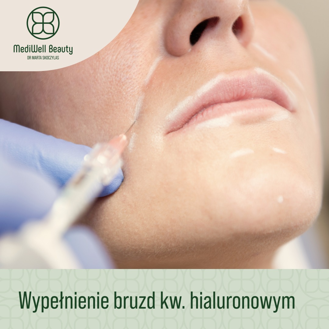 Wypełnianie bruzd nosowo-wargowych kwasem hialuronowym: igła w skórze, zaznaczone linie, zbliżenie na usta.
