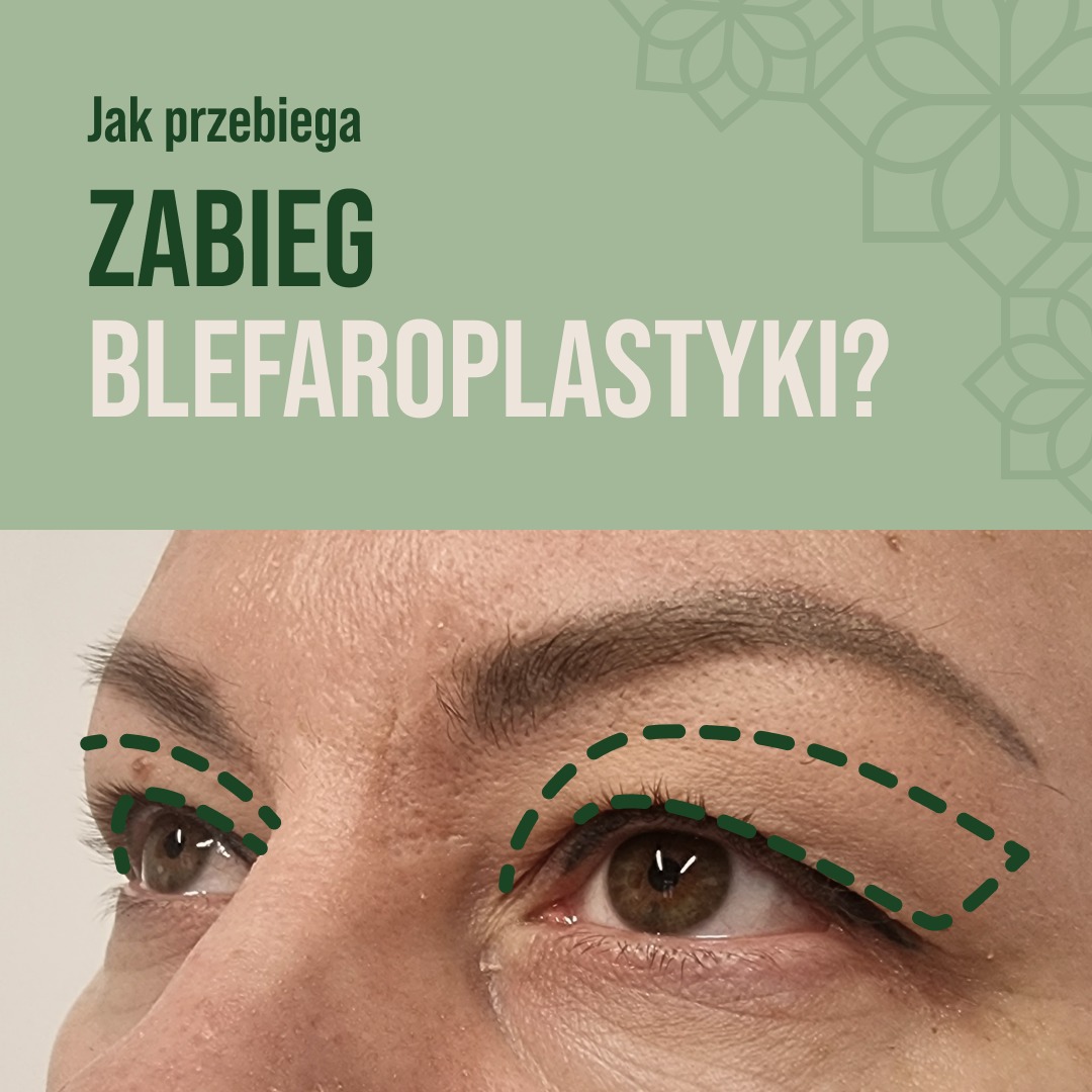 Zbliżenie na oczy kobiety z zaznaczonymi zielonymi liniami przerywanymi obszarami powiek przed zabiegiem plastyki powiek górnych, widoczny fragment tekstu 'Jak przebiega ZABIEG BLEFAROPLASTYKI?'