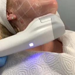 Kobieta podczas zabiegu na twarz z użyciem urządzenia emitującego niebieskie światło, skóra oznaczona białymi liniami, widoczne rękawice ochronne i papierowe podłoże.