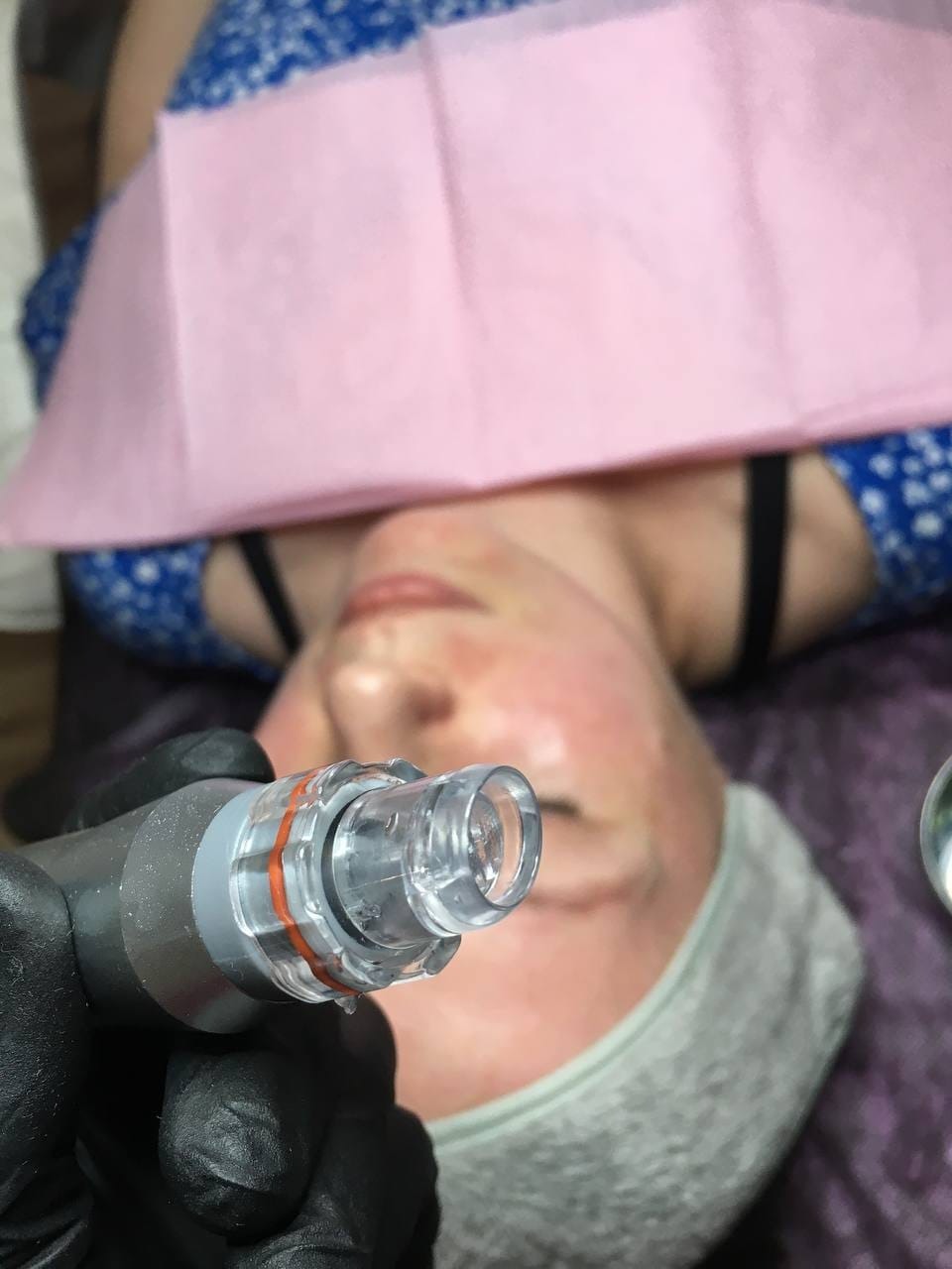Kobieta podczas zabiegu mikrodermabrazji. Widoczna głowica urządzenia w dłoni kosmetologa, twarz klientki z widocznym zaczerwienieniem i ochronną chustą.