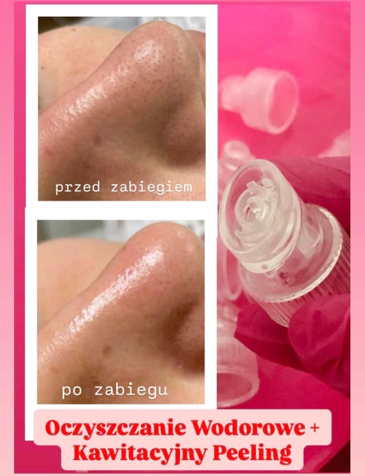 Oczyszczanie wodorowe i kawitacyjny peeling nosa: porównanie stanu skóry przed i po zabiegu. Widoczne zmniejszenie porów i wygładzenie. Urządzenie do zabiegu w tle.