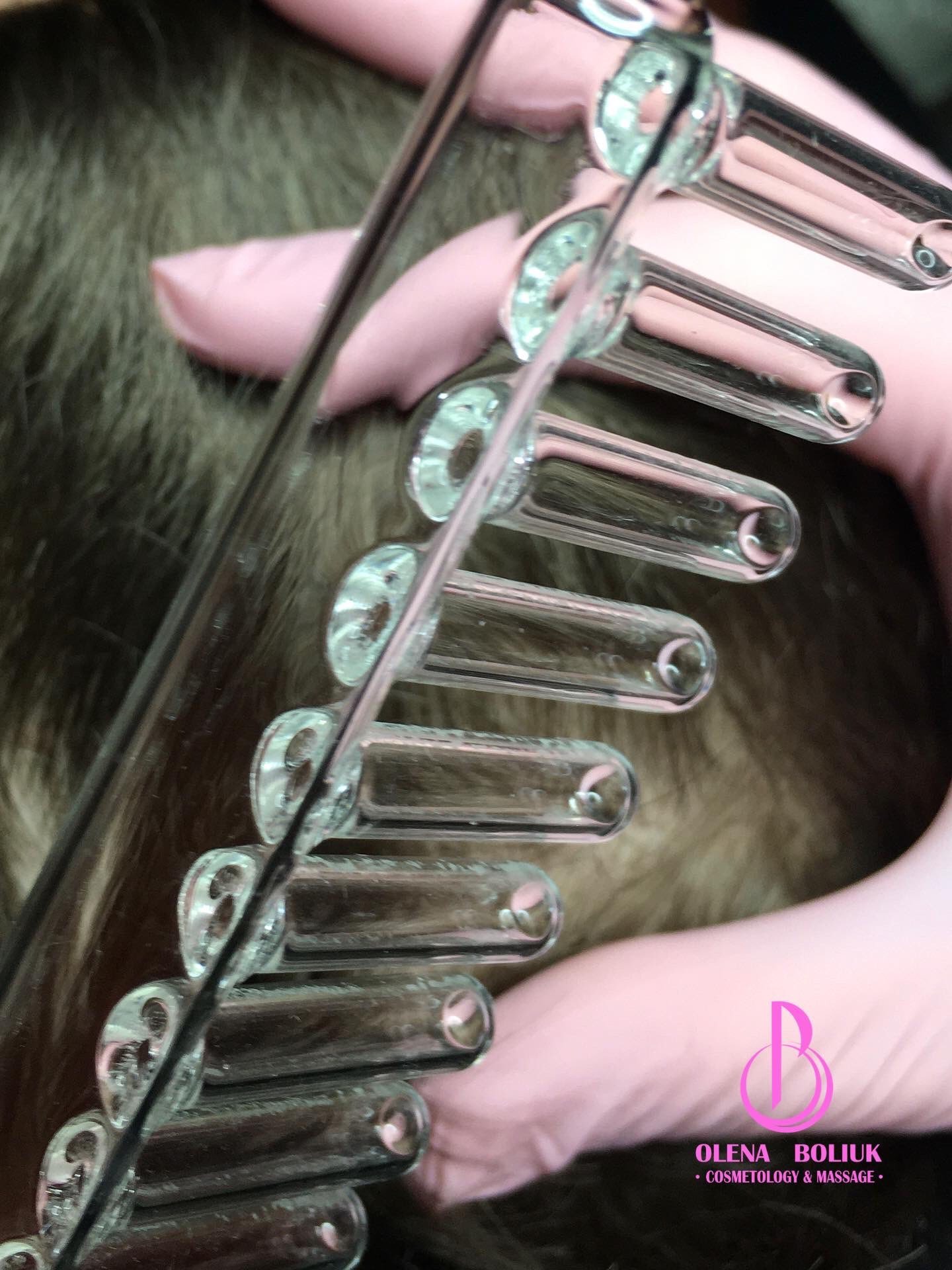 Szklane bańki próżniowe na skórze, dłoń w rękawiczce. Detal zabiegu kosmetycznego z użyciem baniek, bliski kadr, widoczne włosy.