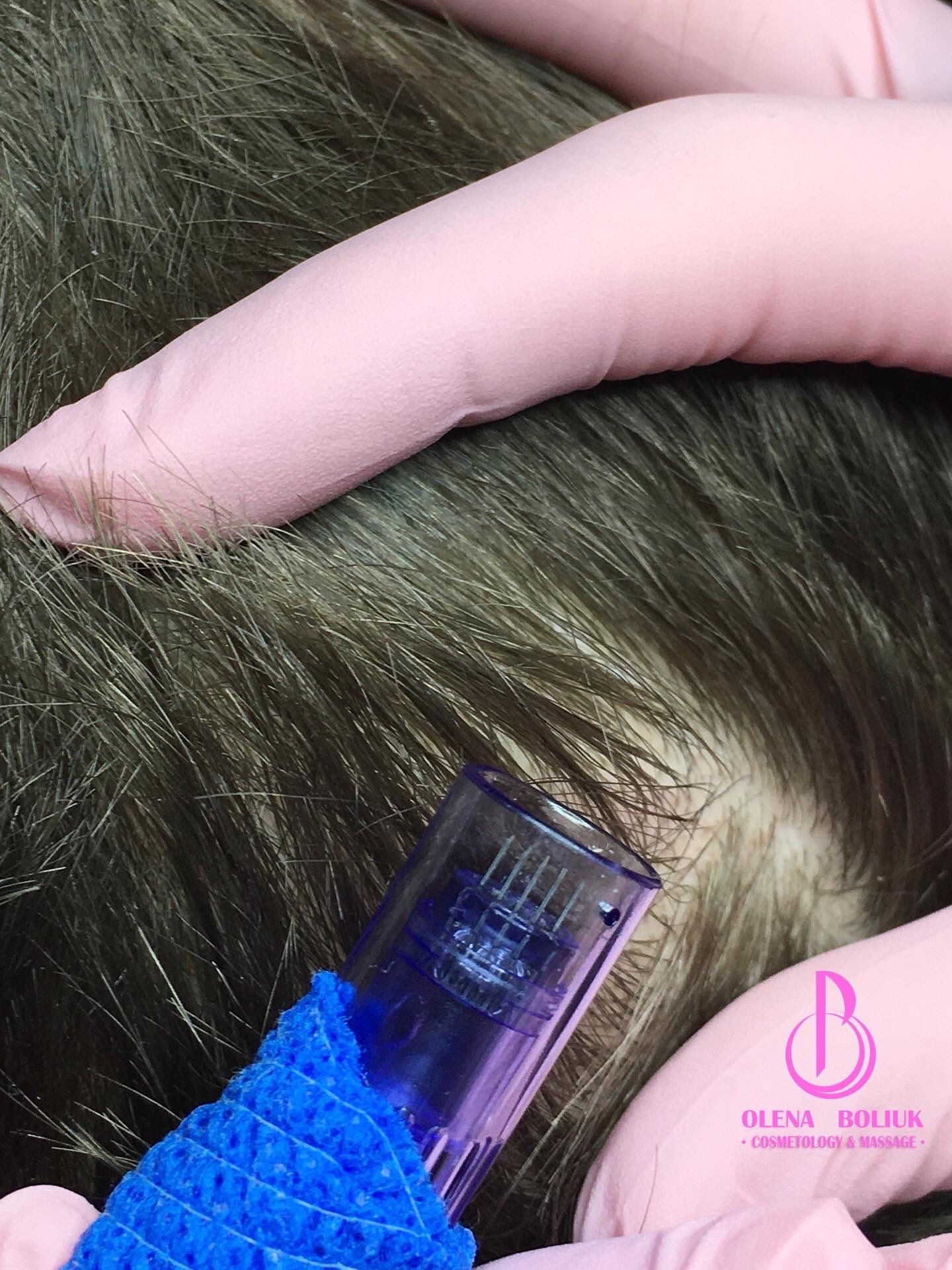 Głowica urządzenia z mikroigłami w dłoniach w rękawiczkach, przykładana do skóry głowy z przerzedzonymi włosami. Zabieg trychologiczny na porost włosów.